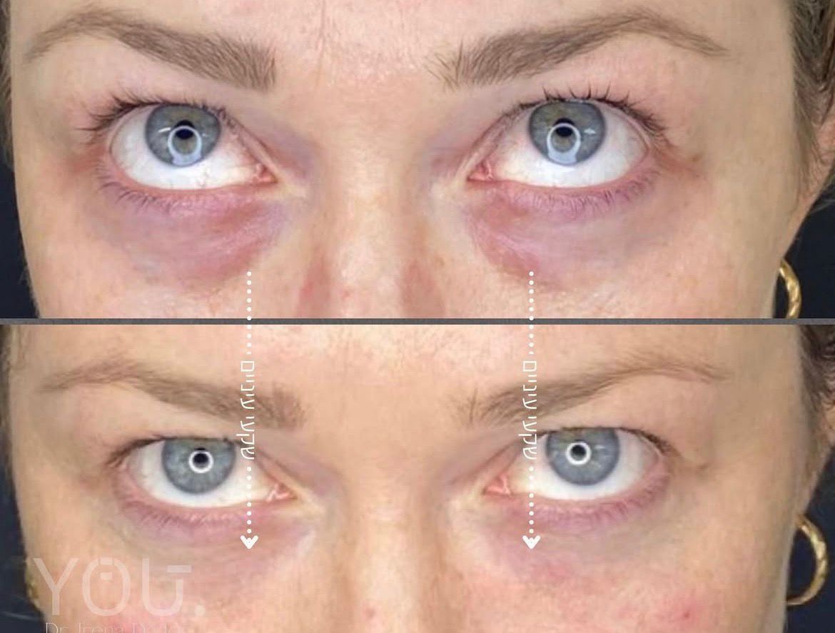 הזרקות זרעי סלמון מתחת לעיניים – ד״ר אירנה דדון