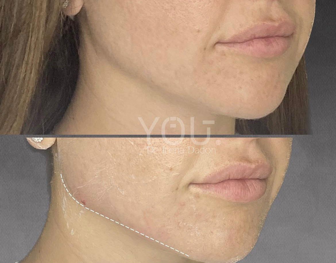 חידוד קו לסת לפני ואחרי – ד״ר אירנה דדון הזרקות בשרון