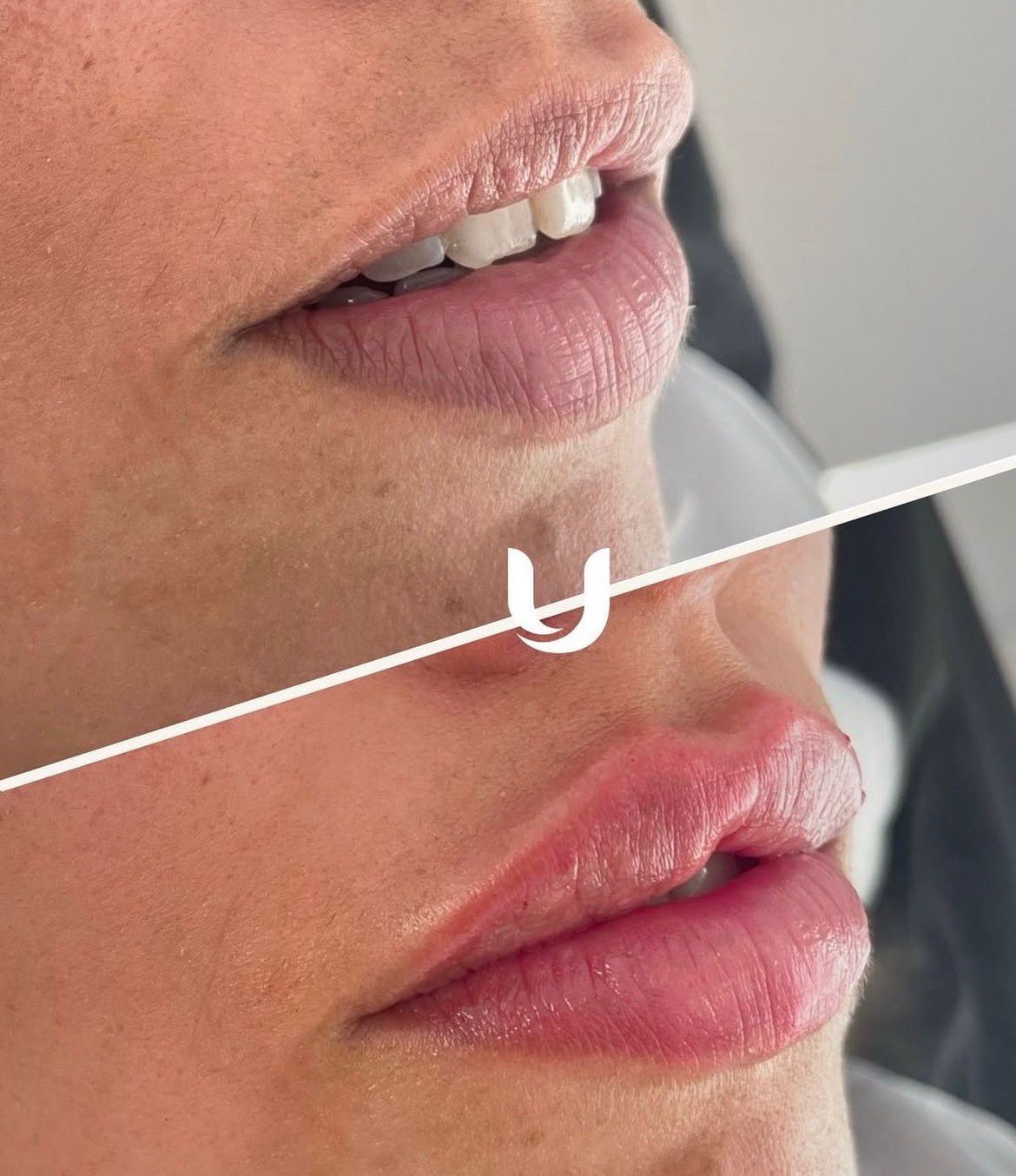 עיצוב שפתיים לפני ואחרי – הזרקות ד״ר אירנה דדון תל מונד