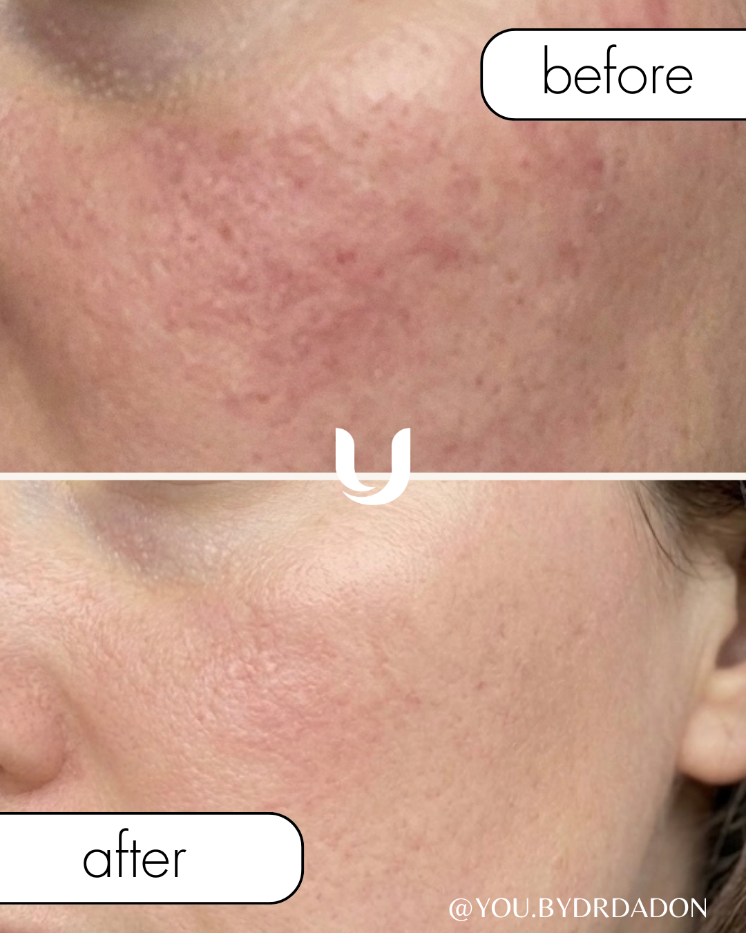 הזרקות זרעי סלמון שיפור מרקם העור – ד״ר אירנה דדון תל מונד